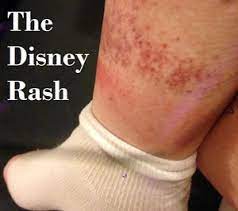 Usa.com provides easy to find states, metro areas, counties, cities, zip codes, and area codes information, including population, races, income, housing, school. The Disney Rash Description Prevention And Treatment Build A Better Mouse Trip