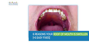 Image result for Canker sores symptoms roof of the mouth