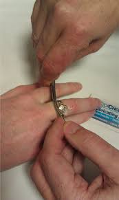 Image result for Ring Removal