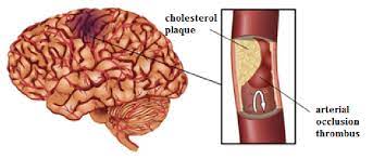 Occurrence Of Cerebral Ischemia Cholesterol Plaque Thrombus Occluding Download Scientific Diagram