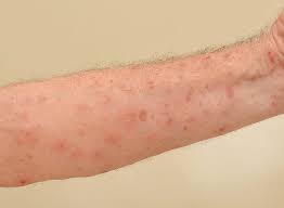 Scabies has been a scourge among human beings for thousands of years. Sarna Brasil Escola