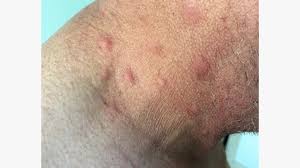 Image result for skin rash acute hiv infection