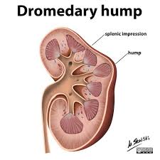 Dromedary Hump Illustration Radiology Case Radiopaedia Org Diagnostic Medical Sonography Radiology Medical Mnemonics