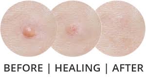 In most cases, cryosurgery is performed on an outpatient basis, and you may need multiple treatments over the course of several weeks or months. Cryotherapy Using Nitrous Oxide N2o Hayes Valley Medical Esthetics