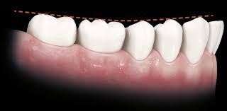 Image result for Occlusal