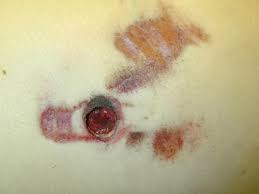 The forensic pathologists examining a gunshot wound should document the type, size, shape, site, and location like in any other injury. Forensic Pathology Of Firearm Wounds Overview Modern Small Arms Epidemiology
