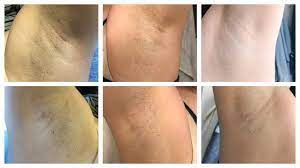 You can shower after your laser hair removal treatment, but make sure you use cool water, and avoid scented soap if possible. Underarm Laser Hair Removal Your Questions Answered