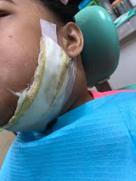 Biasanya, sakit tenggorokan di satu sisi ini ditemani gejala sakit di telinga. Leher Ditebuk Buang Nanah