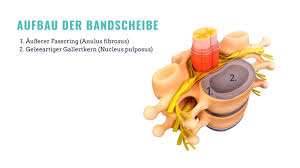 Der gallertkern fängt dabei etwa 75 %, der faserring 25 % der kräfte auf. Bandscheibenvorfall Was Tun Gesunder Rucken