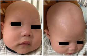 Clinical and genetic analyses of APMR4 syndrome caused by novel biallelic  LSS variants