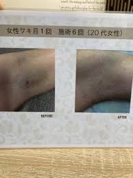 福岡 × 脱毛 × エステ・リラクサロン お得に予約するなら！｜ミニモ