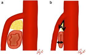 Figure 1 Superior Mesenteric Artery Syndrome A Radiographic Review Springerlink