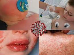 See photos, profile pictures and albums from mx crash & action sport. Covid 19 Children Kawasaki Like Disease What We Know So Far Special Reports Gulf News