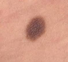 Melanomul Fundatia Romana Contra Cancerului De Piele
