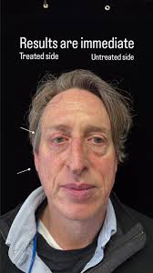 New Anti-Aging Technology!⁠ ⁠ ATTIVA® is a Radiofrequency (RF) System used  to treat saggy skin and overall elasticity. ⁠ ⁠ ATTIVA® S.I.H. Technology  is a PATENTED subdermal induced heat technology ...