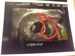 Hematoma Enorme Club De Bebes Enero 2017 Babycenter