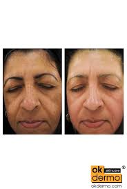 Buy Pure Hydroquinone 4% Cream for Skin Whitening Online