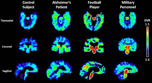 (7 sep 2017) what is cte? Military Personnel Show Brain Changes Similar To Those In Retired Football Players Suspected To Have Cte Ucla