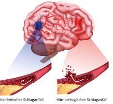 Jemand, der blutungen intern haben oft einen niedrigeren blutdruck und eine höhere pulsfrequenz, als normal. Hirnblutung Symptome Ursachen Und Behandlung Des Hamorrhagischen Schlaganfalls