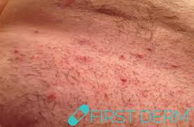 Finally, rinse the area with warm water to wash away the soap. Sex Rash Weird Skin That Shows Your Partner Girlfriend Boyfriend Cheated
