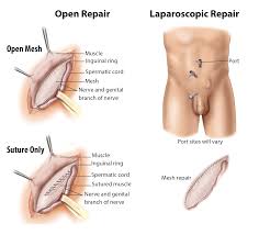 Image result for Inguinal hernia man