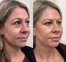 Maggie Cadavero — Botox, Filler, Fat Removal │ Aluma Medical Aesthetics
