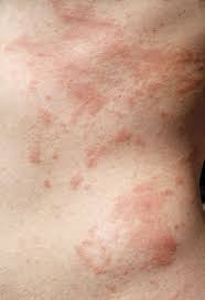 Image result for Rhus Dermatitis