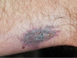 Purpura on the torso and back/face of a child. Retiform Purpura Dermnet Nz