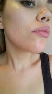 My Roaccutane Review