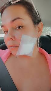 Facial biopsy for lupus diagnosis?