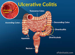 mesothelioma most commonly occurs in the lining of the lungs or the abdomen. Nursing Interventions For Ulcerative Colitisnursing File Nursing File