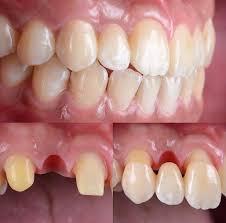 Dental Bridges In Cancun Mexico Dental Design Studio Cancun