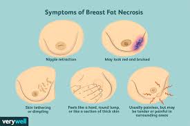 Most lumps (about 80%) aren't cancerous, but you must have them checked by a doctor. Breast Fat Necrosis Symptoms Causes Diagnosis And Treatment