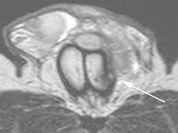 ملف:MRI of ruptured tunica albuginea.jpg - ويكيبيديا