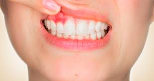 Ai puroi acolo sigur , gingia nu se umfla de capul ei asa. Abces Gingival Tratament Cauze Simptome Clinicile Q Med Bucuresti