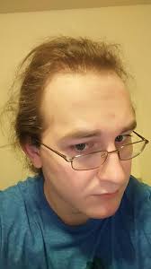 45 entries are tagged with hairline jokes. Am I Balding I Have My Hair Tied Back And I Cant Tell If My Hairline Is Bad Any Help Is Appreciated Bad Hairline My Hair Hairline