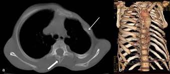 Poland syndrome is noted for the underdevelopment or absence of the chest (pectoralis) muscles on one side of the body as well as webbing of the fingers (cutaneous syndactyly). Left Sided Poland S Syndrome In A Girl With Rare Associations Like Spina Bifida And Diaphragmatic Hernia Bmj Case Reports