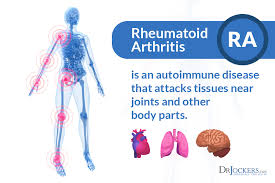 Rheumatoid Arthritis Diet Is Keto The Way Drjockers Com