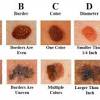 Melanoma is the most serious form of skin cancer because it often spreads to other parts of the body. 1
