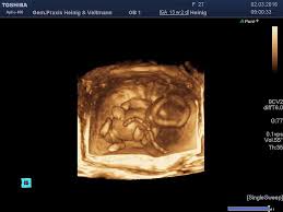 Hallo schön das ihr mich gefunden habt :) heute ist es soweit mein erstes schwangerschafts update zu der 5/6 ssw heute erzähle ich euch wie die erste woche als schwangere war ( weiß es ja erst eine woche ;) ) und zeig euch das erste ultraschall bild von meinem baby und meinen bauch wo man. Praxis Veltmann Heinig Schwangerschaft