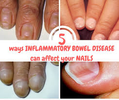 Most commonly, dark stripes down a person's nail are due to a symptom. 5 Ways Ibd Can Affect Your Nails A Balanced Belly