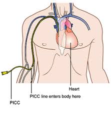 Picc Lines Hyperemesis Gravidarum Not Morning Sickness Not In Our Head No Cracker Or Sea Band Is Ev Child Life Specialist Child Life Nursing Students