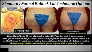 How to expel cellulite on thighs and bum naturally? Creating The Ideal Buttock Lifting Implanting Or Fat Grafting Intechopen
