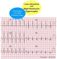 Image result for R Wave