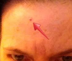 An angioma is a cluster of blood vessels at the surface of the skin and removal is super easy and can be done at home. We Get Old Deal With It You Re My Favorite Today