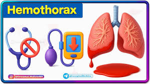 Image result for Hemothorax