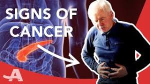Pancreatic cancer that blocks the liver's bile duct can cause jaundice. Early Signs Of Pancreatic Cancer Youtube