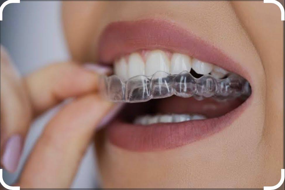 CLEAR ALIGNERS product image