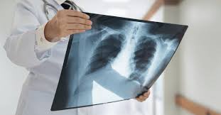 Mesothelioma chest x ray, asbestosdefinition.com |if a met grows very near the chest wall it's very likely to cause pain. Asbestosis Vs Mesothelioma Radiology Scans For Asbestos Diseases