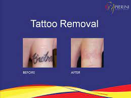 Lasers can remove tattoos without harming the. Laser Tattoo Removal Miami Doral Fort Lauderdale Fl
